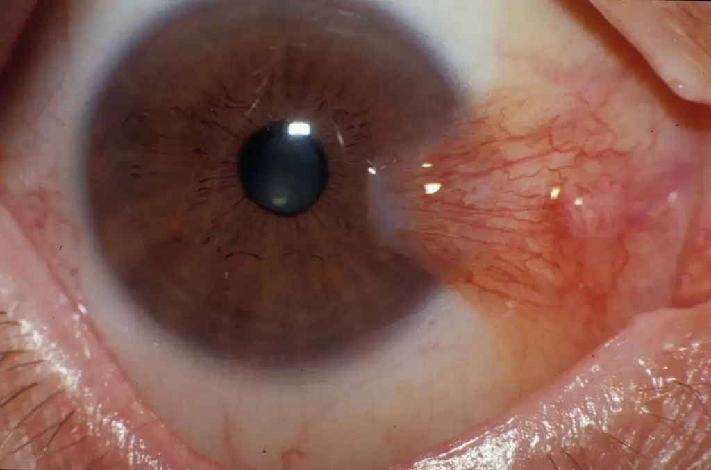 مراقبت های بعد از عمل ناخنک چشم